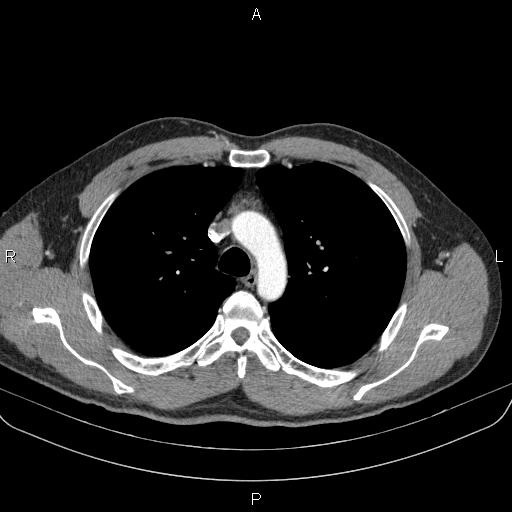 File:Bilateral pulmonary AVM (Radiopaedia 83134-97505 A 23).jpg