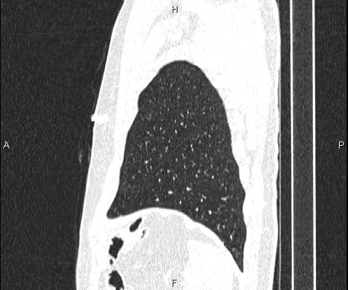 Bilateral pulmonary AVM (Radiopaedia 83134-97505 Sagittal lung window 98).jpg