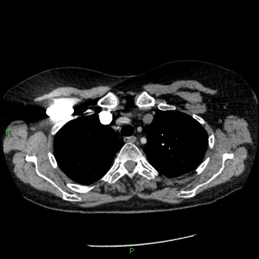 Bilateral pulmonary emboli (Radiopaedia 32700-33669 Axial C+ CTPA 20).jpg