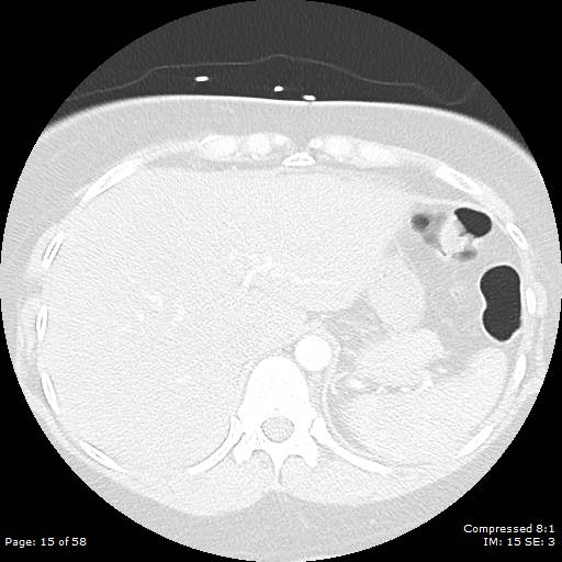 Bilateral pulmonary emboli with Hampton hump sign (Radiopaedia 54070-60246 Axial lung window 15).jpg