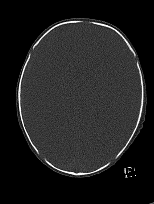 Bilateral subdural hemorrhage and parietal skull fracture (Radiopaedia 26058-26192 Axial bone window 56).png