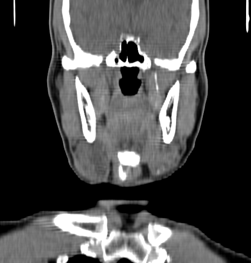 Bilateral submandibular sialolithiasis with sialadenitis (Radiopaedia 70721-80881 Coronal non-contrast 30).jpg