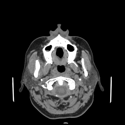 Bisphosphonate-related osteonecrosis of the jaw (Radiopaedia 71324-81642 non-contrast 116).jpg