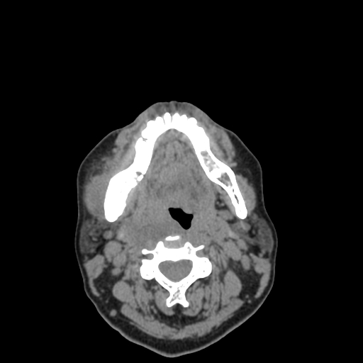 Bisphosphonate-related osteonecrosis of the jaw (Radiopaedia 71324-81642 non-contrast 60).jpg