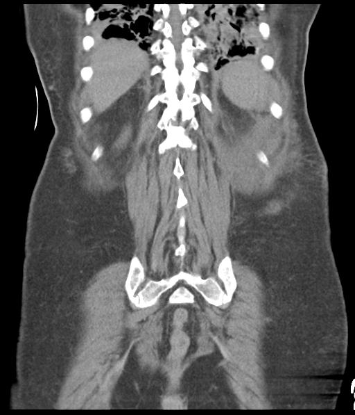 Bladder rupture post renal biopsy (Radiopaedia 30863-31572 Coronal non-contrast 48).jpg