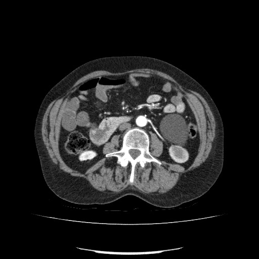 Bladder tumor detected on trauma CT (Radiopaedia 51809-57609 A 120).jpg