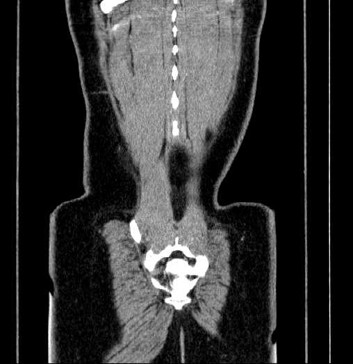 Blind-ending branch of a bifid ureter (Radiopaedia 61159-69048 C 67).jpg