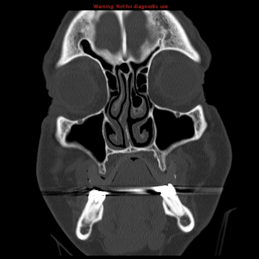 File:Blowout fracture with inferior rectus entrapment (Radiopaedia 12418-12673 Coronal bone window 1).jpg