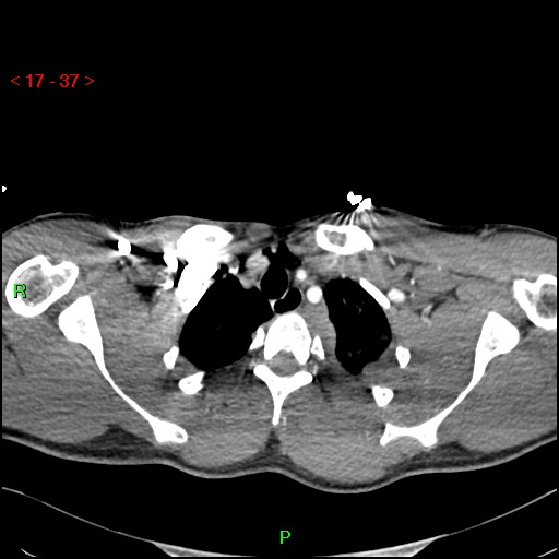 Blunt thoracic trauma (Radiopaedia 73454-84221 Axial soft tissues 14).jpg