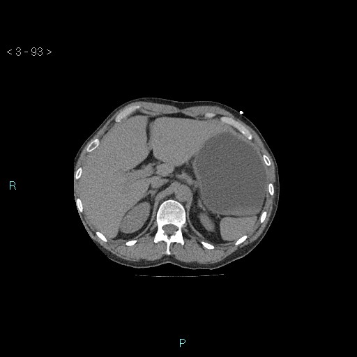 Boerhaave syndrome (Radiopaedia 27683-27897 Axial non-contrast 93).jpg