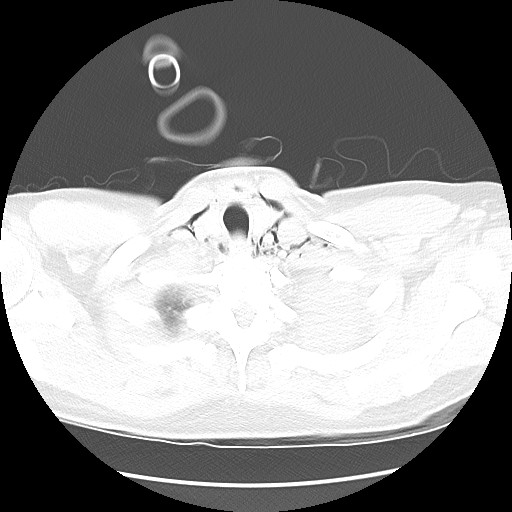 File:Boerhaave syndrome (Radiopaedia 59796-67310 Axial lung window 9).jpg