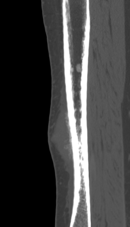 Bone metastasis - tibia (Radiopaedia 57665-64609 Sagittal bone window 58).jpg