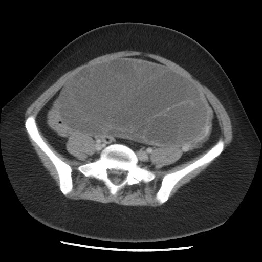 File:Borderline mucinous tumor (ovary) (Radiopaedia 78228-90808 A 110).jpg