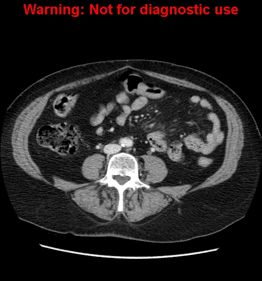 File:Bosniak renal cyst - type II (Radiopaedia 23404-23468 D 41).jpg
