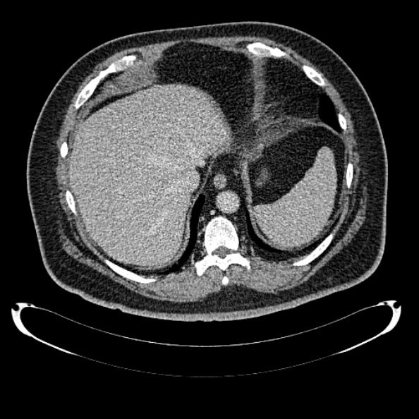 Bosniak renal cyst - type IV (Radiopaedia 24244-24518 C 35).jpg