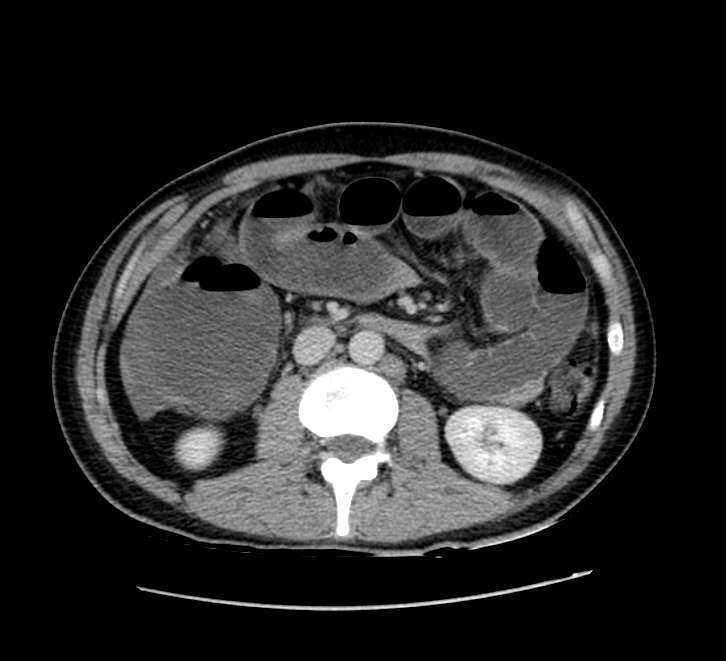 Bowel obstruction from colon carcinoma (Radiopaedia 22995-23028 A 38).jpg