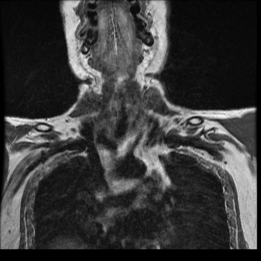 File:Brachial plexus neurofibroma (Radiopaedia 28030-28291 Coronal T1 13).png