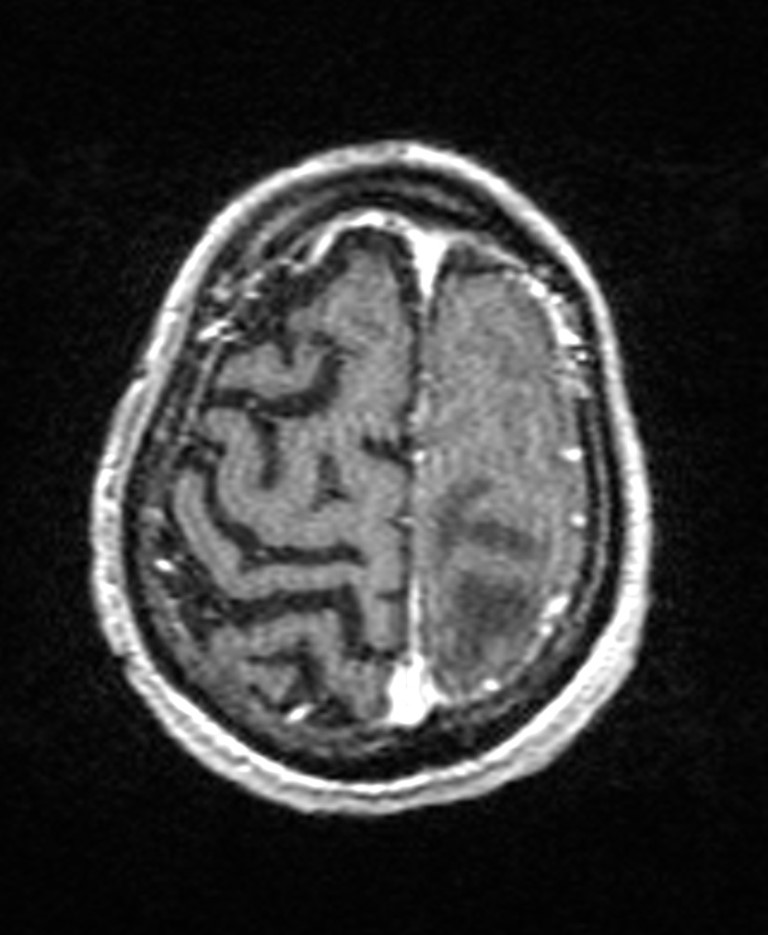 Brain abscess with dual rim sign (Radiopaedia 87566-103938 Axial T1 C+ 137).jpg