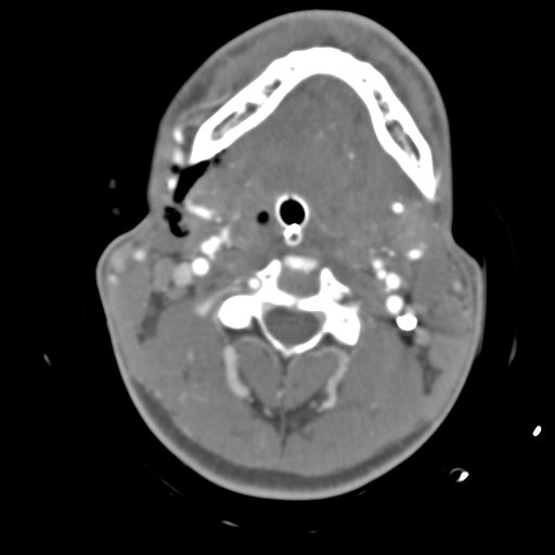 Brain contusions, internal carotid artery dissection and base of skull fracture (Radiopaedia 34089-35339 D 66).png