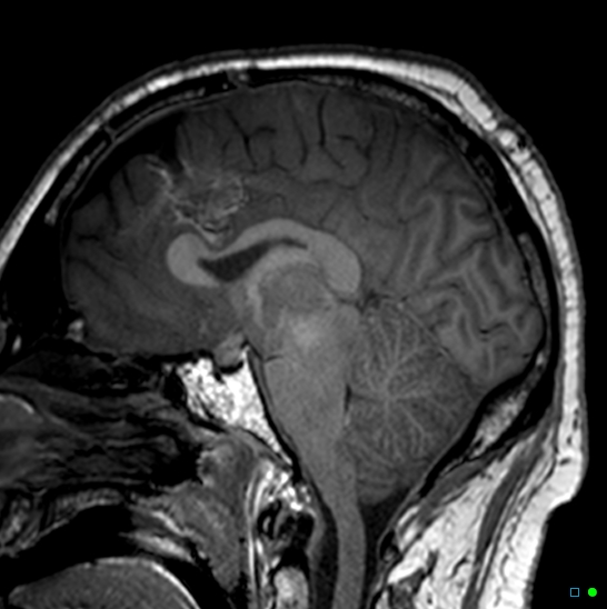 Brain death on MRI and CT angiography (Radiopaedia 42560-45689 Sagittal T1 27).jpg