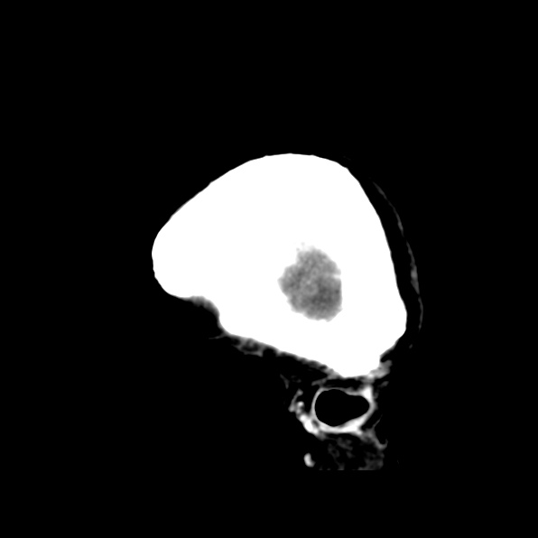 File:Brain metastases from breast cancer (Radiopaedia 23178-23231 C 5).jpg