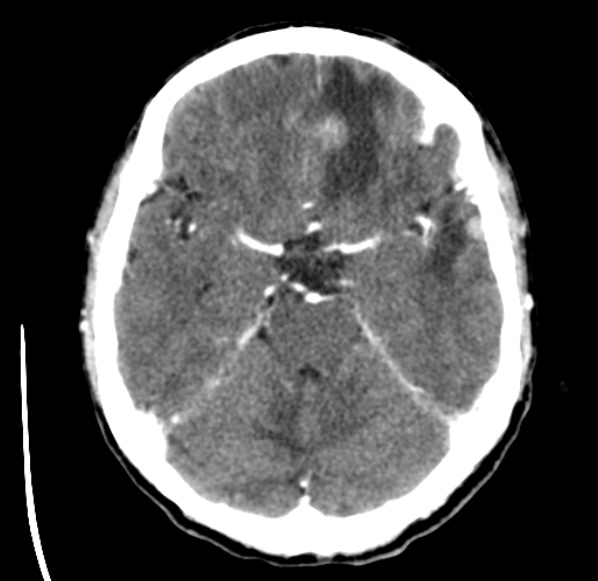 File:Brain metastases from lung cancer (Radiopaedia 24480-24781 Axial C+ delayed 19).jpg