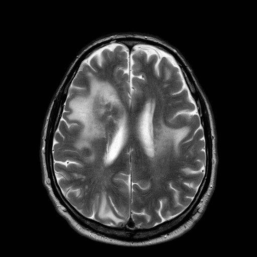 File:Brain metastases from lung cancer (Radiopaedia 83839-99028 Axial T2 23).jpg