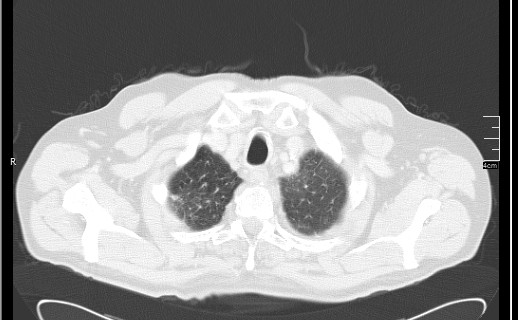Brain metastases from squamocellular lung cancer (Radiopaedia 56515-63219 Axial lung window 13).jpg