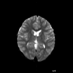 File:Brainstem ganglioglioma (Radiopaedia 10763-11224 Axial DWI 9).jpg