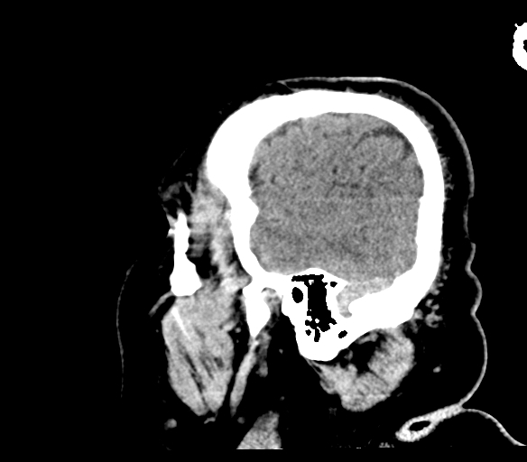 Brainstem hemorrhage (Radiopaedia 81294-94976 C 51).jpg