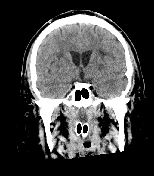 Brainstem hemorrhage (Radiopaedia 81294-94976 Coronal non-contrast 31).jpg