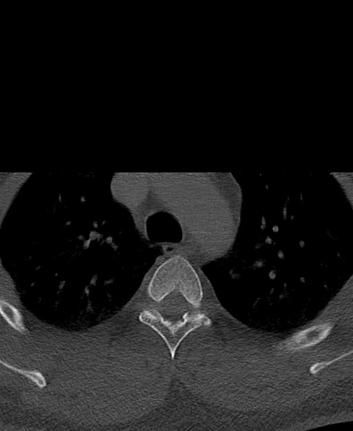 Branchial cleft cyst (Radiopaedia 31167-31875 Axial bone window 84).jpg