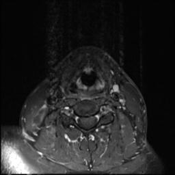 File:Branchial cleft cyst (Radiopaedia 31167-31876 Axial T1 C+ fat sat 5).jpg