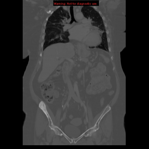 Breast cancer metastasis (Radiopaedia 10001-10554 B 31).jpg