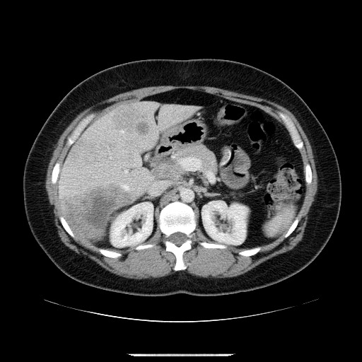 File:Breast cancer pseudocirrhosis after chemotherapy (Radiopaedia 65407-74456 A 30).jpg