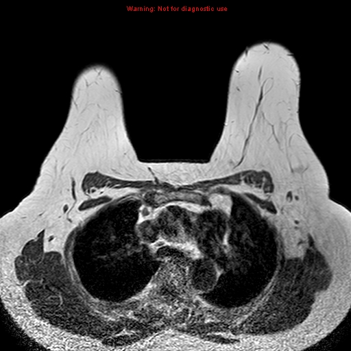 File:Breast carcinoma (multicentric multifocal in mammary Paget disease) (Radiopaedia 50966-56512 Axial T1 13).jpg