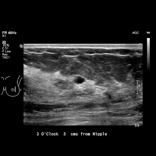 File:Breast metastases from renal cell cancer (Radiopaedia 79220-92226 Left breast US 14).jpeg