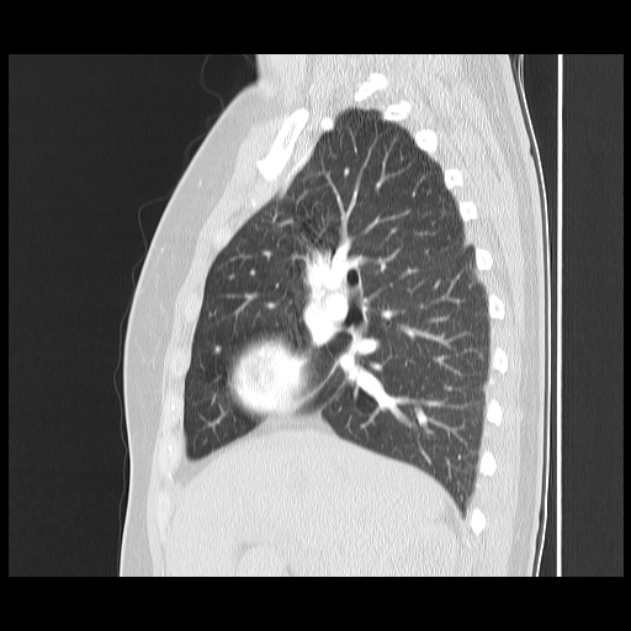 Bronchial atresia (Radiopaedia 22965-22992 Sagittal lung window 35).jpg