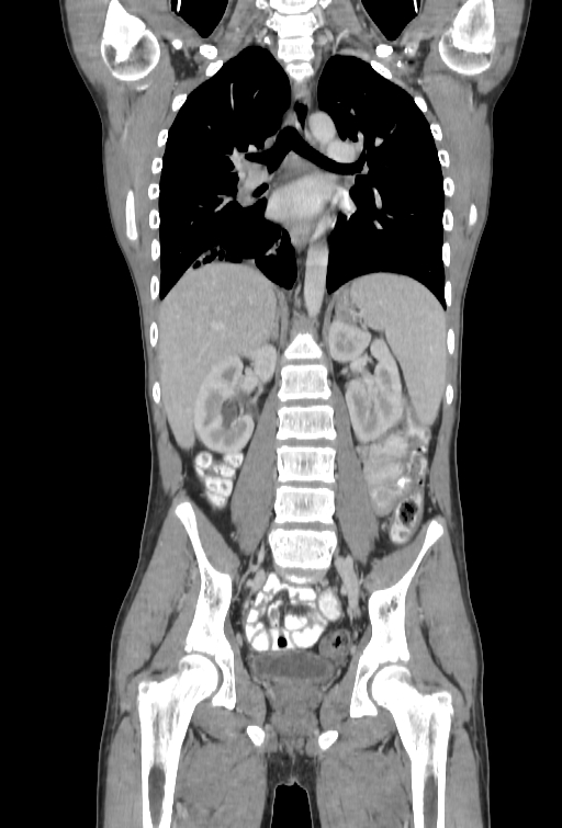 Bronchial carcinoid tumor (Radiopaedia 57187-64090 B 66).jpg