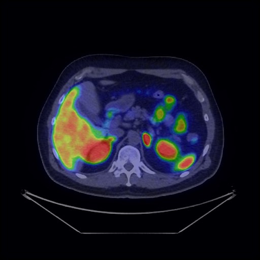 Bronchial carcinoid tumor (Radiopaedia 67377-76765 68Ga-DOTATATE PET-CT 44).jpg