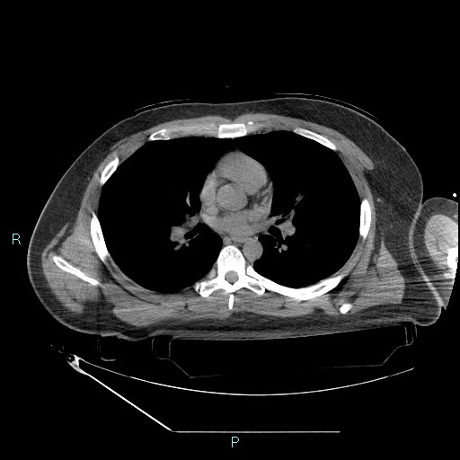 Bronchial carcinoid tumor (Radiopaedia 78272-90870 Axial non-contrast 52).jpg