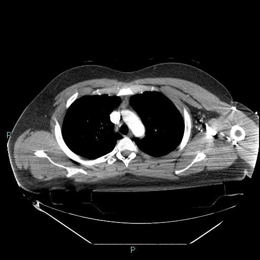 Bronchial carcinoid tumor (Radiopaedia 78272-90870 B 38).jpg