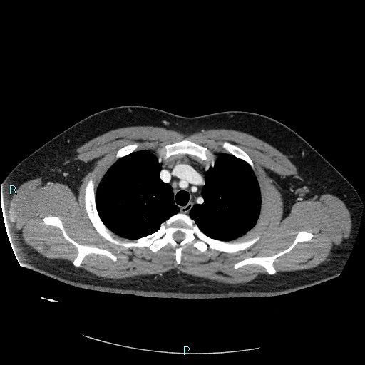 Bronchial carcinoid tumor (Radiopaedia 78272-90875 A 26).jpg