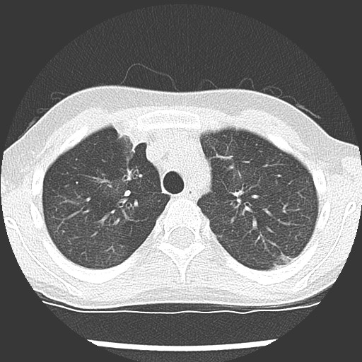Bronchiolotis obliterans (Radiopaedia 73769-84575 Axial lung window 14).jpg