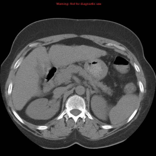 File:Bronchoalveolar carcinoma (Radiopaedia 13224-13233 Axial non-contrast 52).jpg