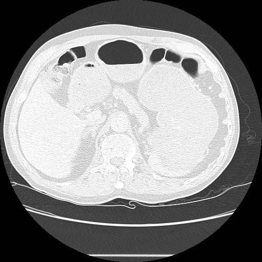 Bronchocele (Radiopaedia 17097-16795 Axial lung window 120).jpg