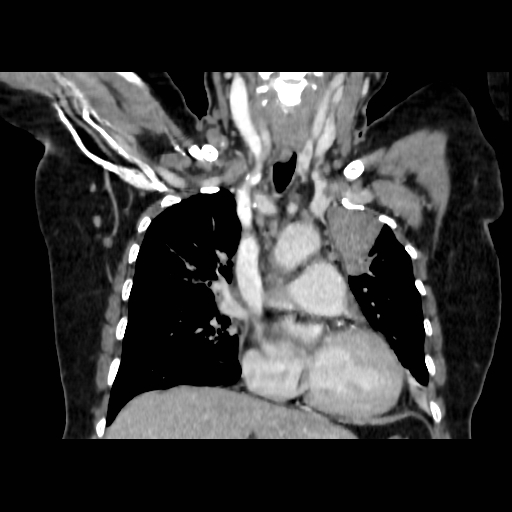 Bronchogenic carcinoma (Radiopaedia 73497-84262 C 58).jpg
