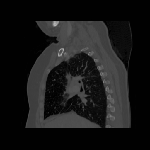 Bronchogenic carcinoma (Radiopaedia 73497-84262 Sagittal bone window 67).jpg