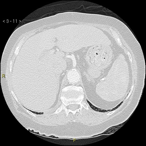 Bronchogenic carcinoma as an incidental finding (Radiopaedia 16453-16130 Axial lung window 11).jpg