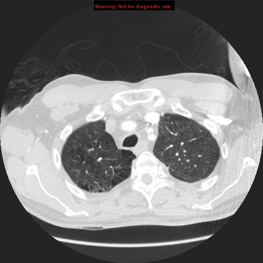 File:Bronchogenic carcinoma brain metastasis (Radiopaedia 9286-105832 Axial lung window 29).jpg